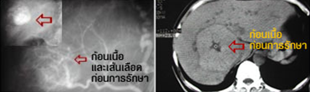 การรักษามะเร็งตับด้วยวิธีผ่านหลอดเลือด