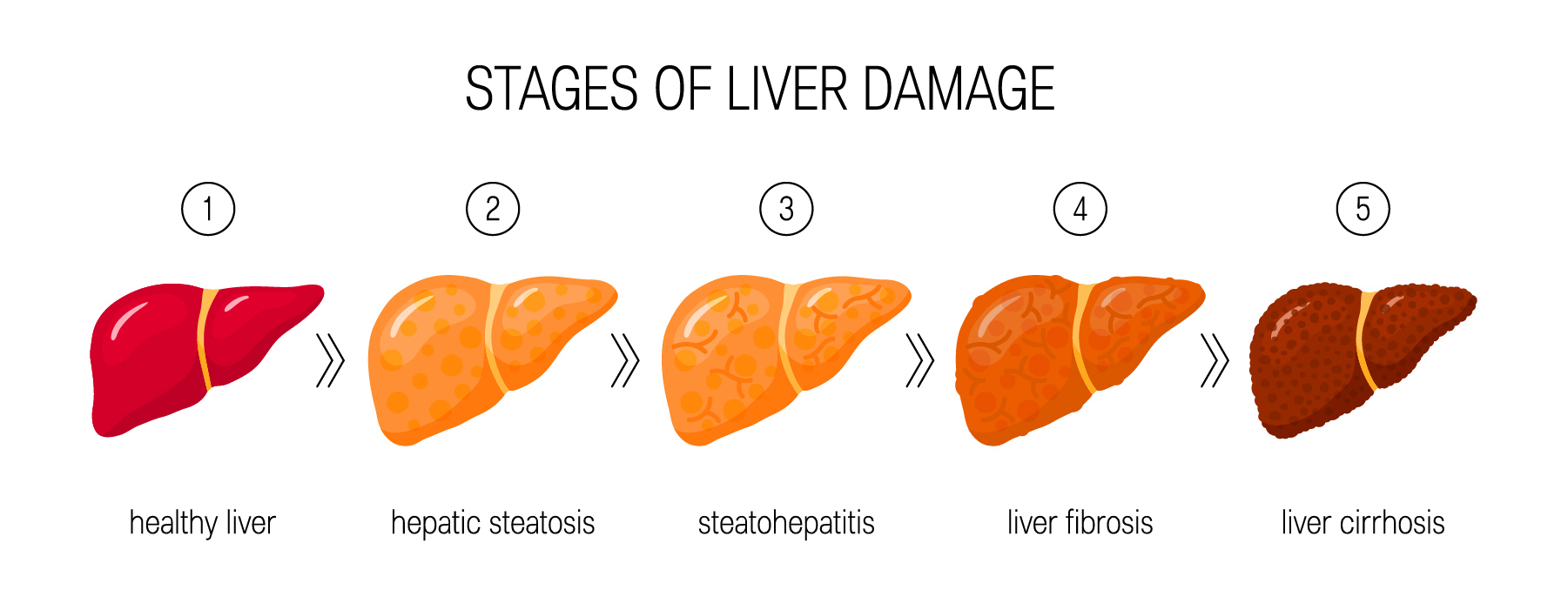 ตับแตก Steatohepatitis